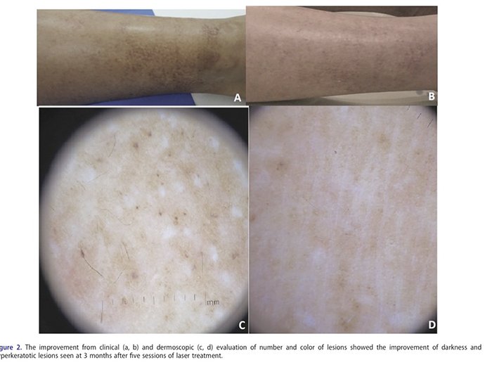 ผื่น lichen amyloidosus (หรือ amyloidosis) มีลักษณะอย่างไร ดูแลได้อย่างไร ผื่น lichen amyloidosus (หรือ amyloidosis) มีลักษณะอย่างไร ดูแลได้อย่างไร