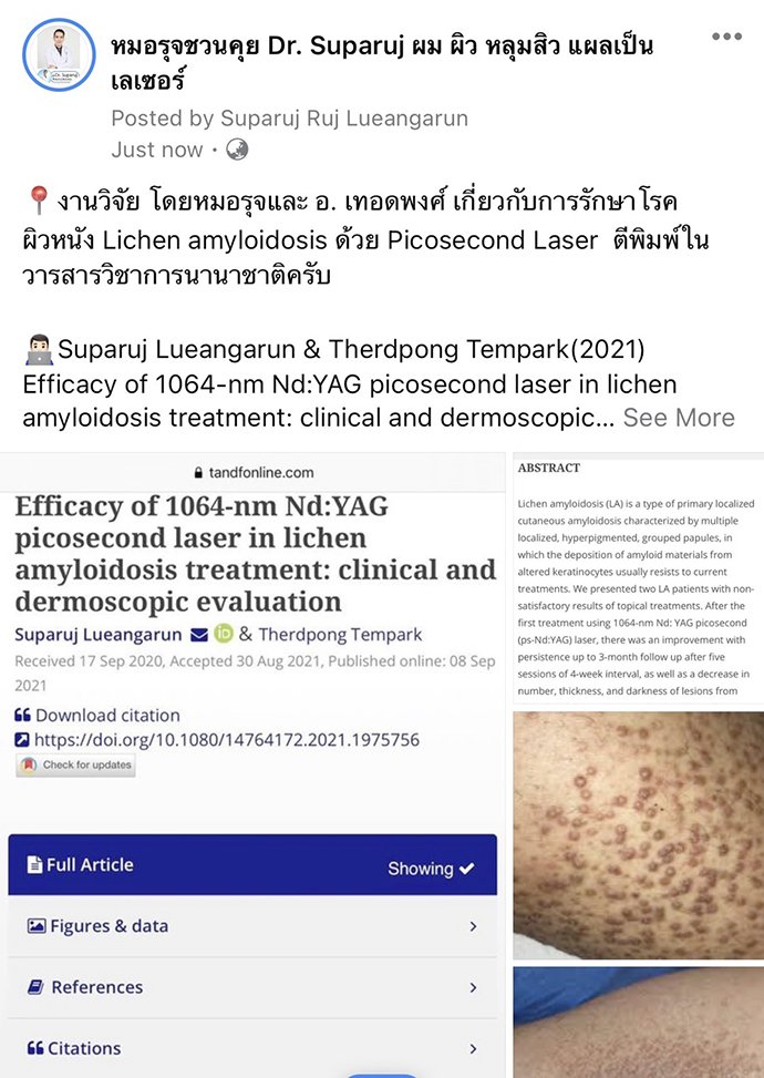 ผื่น lichen amyloidosus (หรือ amyloidosis) มีลักษณะอย่างไร ดูแลได้อย่างไร ผื่น lichen amyloidosus (หรือ amyloidosis) มีลักษณะอย่างไร ดูแลได้อย่างไร