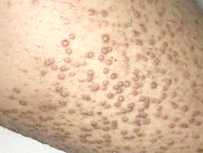 ผื่น lichen amyloidosus (หรือ amyloidosis) มีลักษณะอย่างไร ดูแลได้อย่างไร ผื่น lichen amyloidosus (หรือ amyloidosis) มีลักษณะอย่างไร ดูแลได้อย่างไร