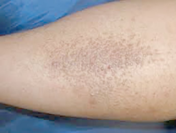 ผื่น lichen amyloidosus (หรือ amyloidosis) มีลักษณะอย่างไร ดูแลได้อย่างไร ผื่น lichen amyloidosus (หรือ amyloidosis) มีลักษณะอย่างไร ดูแลได้อย่างไร