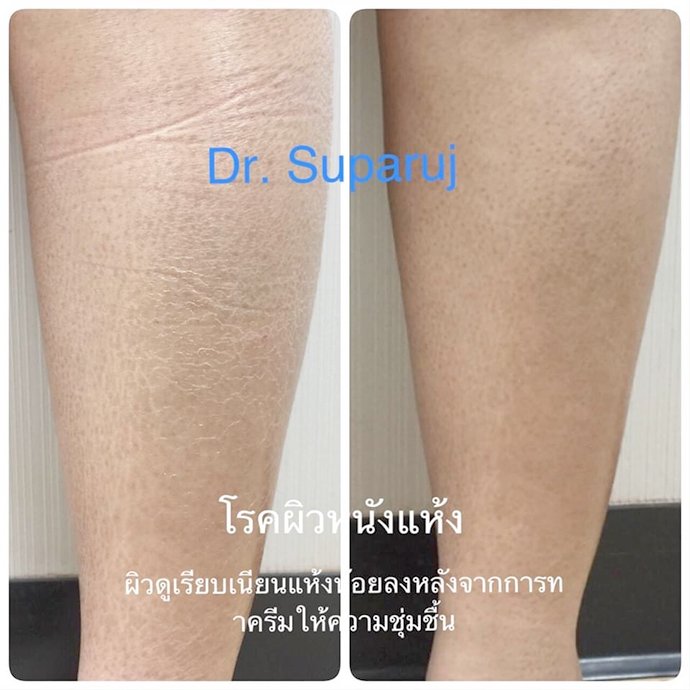 เทคนิคนิคการเลือก Moisturizer ครีมให้ความชุ่มชื้นผิว เทคนิคนิคการเลือก Moisturizer ครีมให้ความชุ่มชื้นผิว