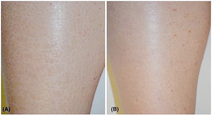 เทคนิคนิคการเลือก Moisturizer ครีมให้ความชุ่มชื้นผิว เทคนิคนิคการเลือก Moisturizer ครีมให้ความชุ่มชื้นผิว