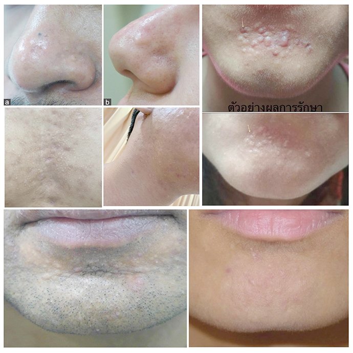 แผลเป็นจากสิวแบบนูน Papular acne scar คืออะไร ?ดูแลได้อย่างไร ?