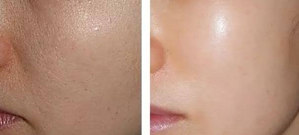 REJURAN HEALER เทคโนโลยี PN Polynucleotide ดูแลปัญหาหลุมสิว REJURAN HEALER เทคโนโลยี PN Polynucleotide ดูแลปัญหาหลุมสิว