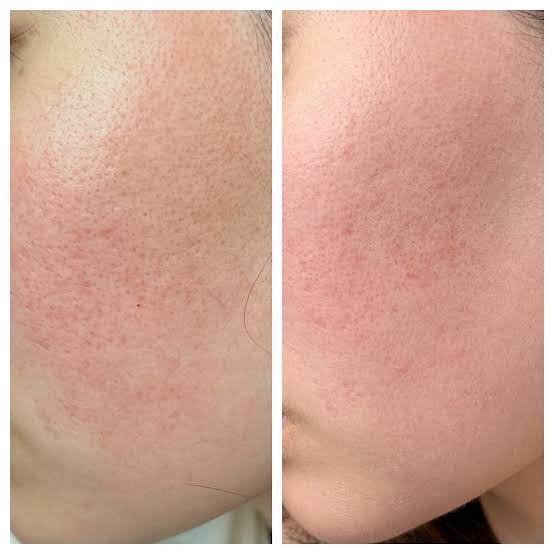 REJURAN HEALER เทคโนโลยี PN Polynucleotide ดูแลปัญหาหลุมสิว REJURAN HEALER เทคโนโลยี PN Polynucleotide ดูแลปัญหาหลุมสิว