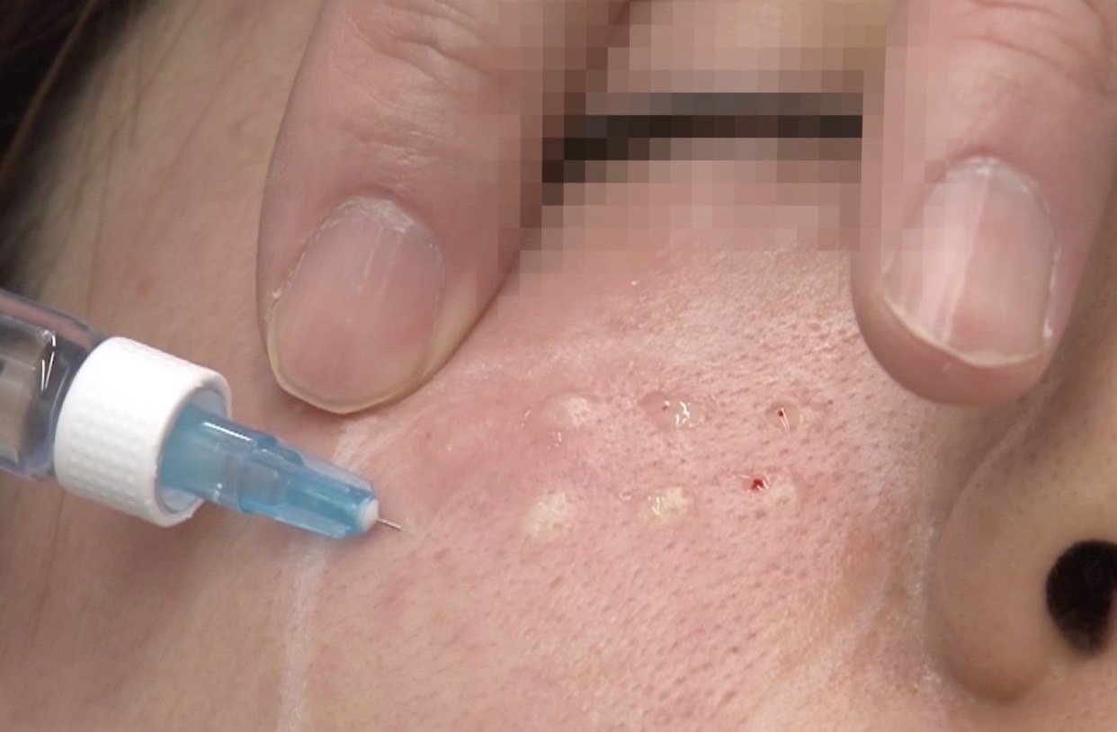 REJURAN HEALER เทคโนโลยี PN Polynucleotide ดูแลปัญหาหลุมสิว REJURAN HEALER เทคโนโลยี PN Polynucleotide ดูแลปัญหาหลุมสิว