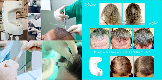 ดูแลผมร่วง ผมบางด้วย Regenera Hair Stem Cell Therapy !!