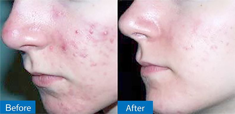 กดสิวดีไหม กดแล้วช่วยให้สิวหายเร็วขึ้นจริงไหม ? กดสิวดีไหม กดแล้วช่วยให้สิวหายเร็วขึ้นจริงไหม ?