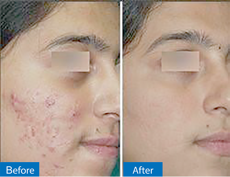 กดสิวดีไหม กดแล้วช่วยให้สิวหายเร็วขึ้นจริงไหม ? กดสิวดีไหม กดแล้วช่วยให้สิวหายเร็วขึ้นจริงไหม ?