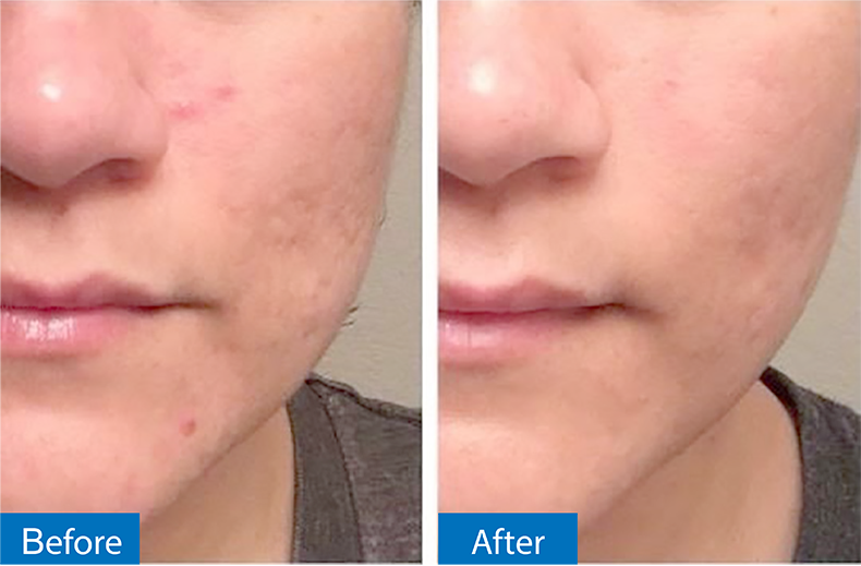 กดสิวดีไหม กดแล้วช่วยให้สิวหายเร็วขึ้นจริงไหม ? กดสิวดีไหม กดแล้วช่วยให้สิวหายเร็วขึ้นจริงไหม ?