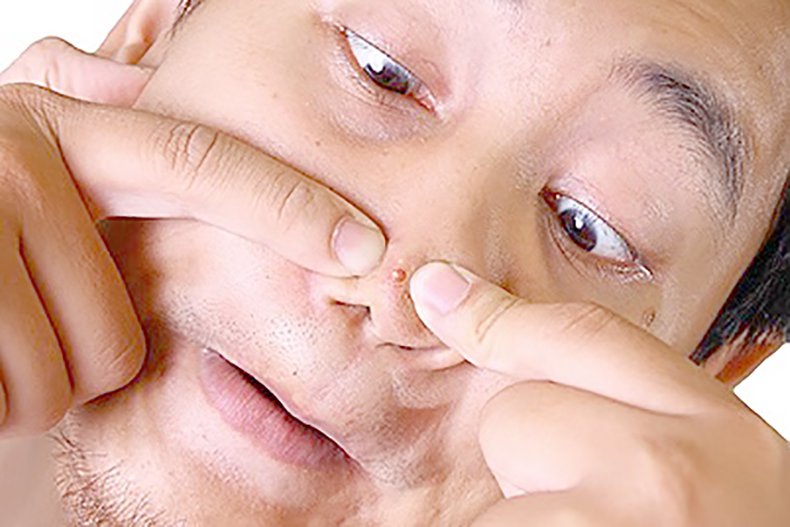 กดสิวดีไหม กดแล้วช่วยให้สิวหายเร็วขึ้นจริงไหม ? กดสิวดีไหม กดแล้วช่วยให้สิวหายเร็วขึ้นจริงไหม ?