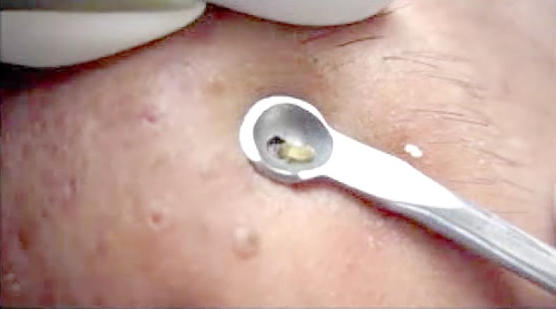 กดสิวดีไหม กดแล้วช่วยให้สิวหายเร็วขึ้นจริงไหม ? กดสิวดีไหม กดแล้วช่วยให้สิวหายเร็วขึ้นจริงไหม ?