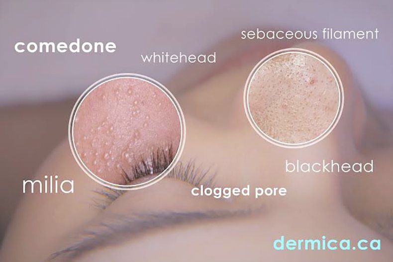 กดสิวดีไหม กดแล้วช่วยให้สิวหายเร็วขึ้นจริงไหม ? กดสิวดีไหม กดแล้วช่วยให้สิวหายเร็วขึ้นจริงไหม ?