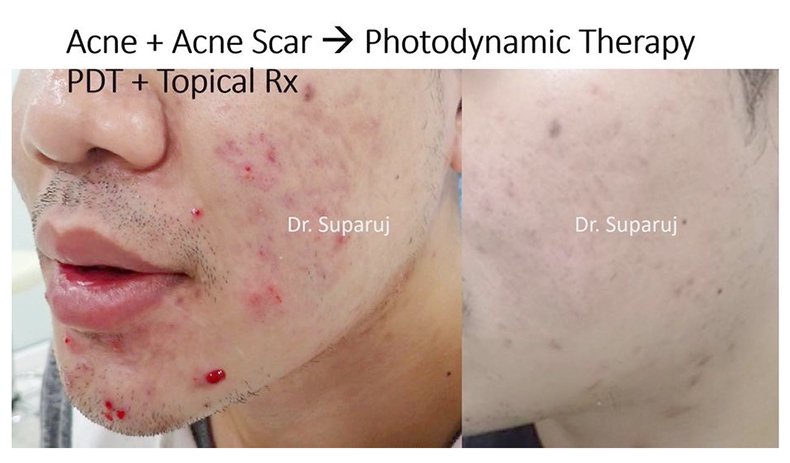 กดสิวดีไหม กดแล้วช่วยให้สิวหายเร็วขึ้นจริงไหม ? กดสิวดีไหม กดแล้วช่วยให้สิวหายเร็วขึ้นจริงไหม ?