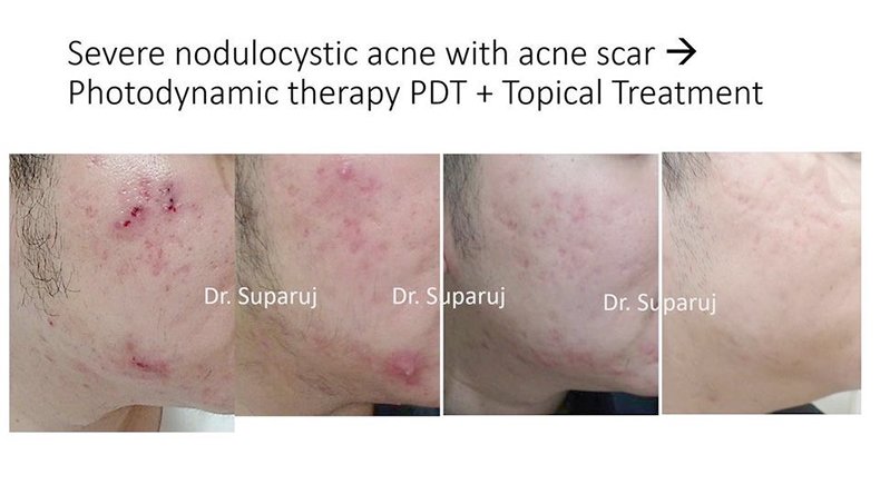 กดสิวดีไหม กดแล้วช่วยให้สิวหายเร็วขึ้นจริงไหม ? กดสิวดีไหม กดแล้วช่วยให้สิวหายเร็วขึ้นจริงไหม ?