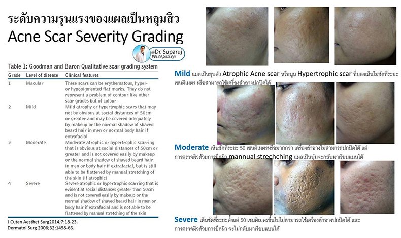 กดสิวดีไหม กดแล้วช่วยให้สิวหายเร็วขึ้นจริงไหม ? กดสิวดีไหม กดแล้วช่วยให้สิวหายเร็วขึ้นจริงไหม ?