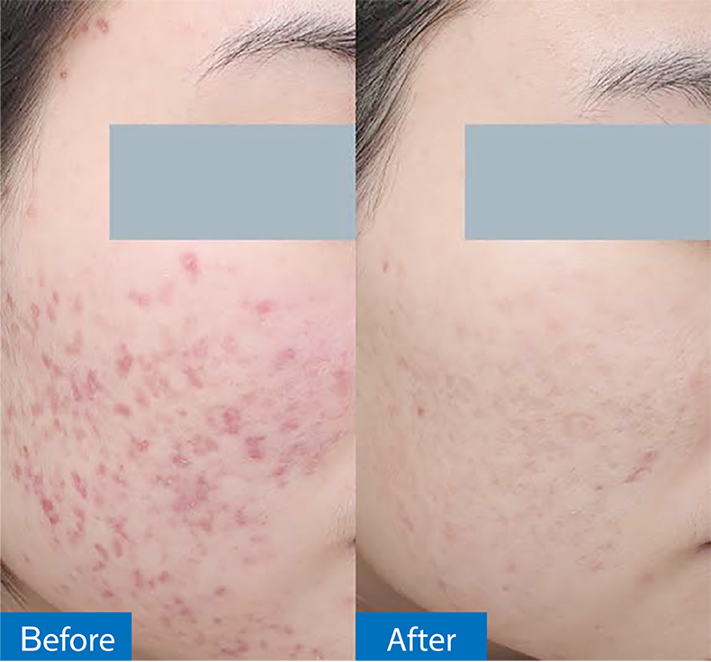 กดสิวดีไหม กดแล้วช่วยให้สิวหายเร็วขึ้นจริงไหม ? กดสิวดีไหม กดแล้วช่วยให้สิวหายเร็วขึ้นจริงไหม ?