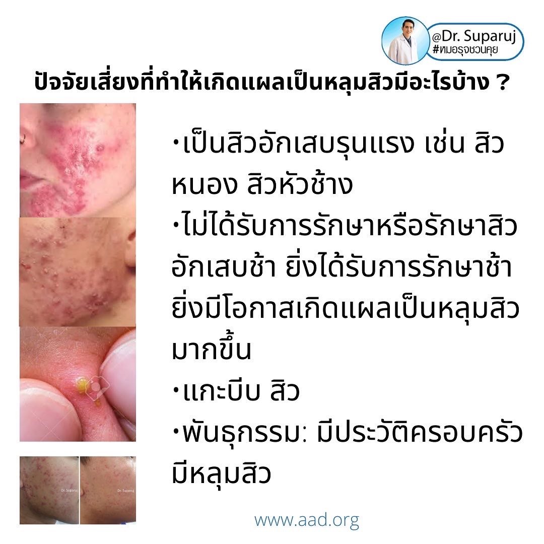 ปัจจัยเสี่ยงที่ทำให้เกิดแผลเป็นหลุมสิวมีอะไรบ้าง ? และปัองกันการเกิดแผลเป็นหลุมสิวได้อย่างไร ? ปัจจัยเสี่ยงที่ทำให้เกิดแผลเป็นหลุมสิวมีอะไรบ้าง ? และปัองกันการเกิดแผลเป็นหลุมสิวได้อย่างไร ?