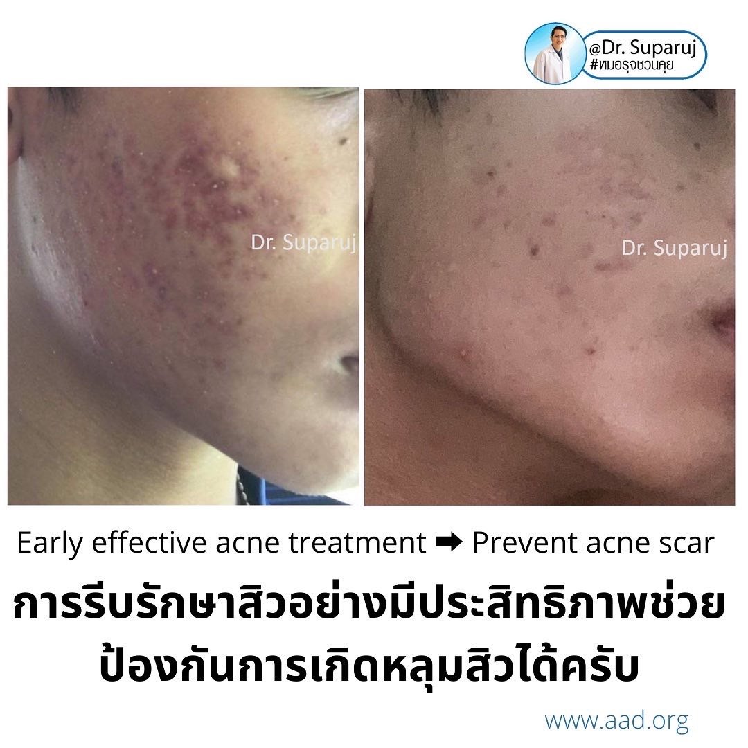 ปัจจัยเสี่ยงที่ทำให้เกิดแผลเป็นหลุมสิวมีอะไรบ้าง ? และปัองกันการเกิดแผลเป็นหลุมสิวได้อย่างไร ? ปัจจัยเสี่ยงที่ทำให้เกิดแผลเป็นหลุมสิวมีอะไรบ้าง ? และปัองกันการเกิดแผลเป็นหลุมสิวได้อย่างไร ?