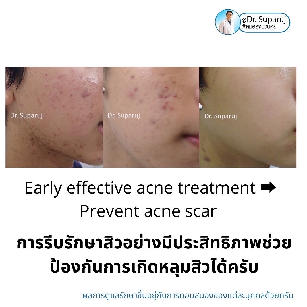 ปัจจัยเสี่ยงที่ทำให้เกิดแผลเป็นหลุมสิวมีอะไรบ้าง ? และปัองกันการเกิดแผลเป็นหลุมสิวได้อย่างไร ? ปัจจัยเสี่ยงที่ทำให้เกิดแผลเป็นหลุมสิวมีอะไรบ้าง ? และปัองกันการเกิดแผลเป็นหลุมสิวได้อย่างไร ?