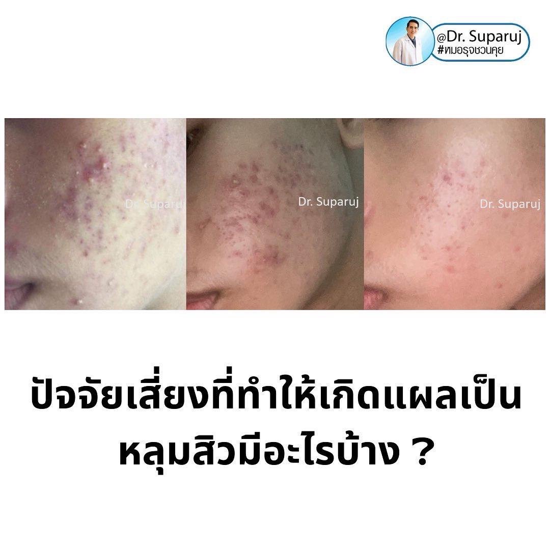 ปัจจัยเสี่ยงที่ทำให้เกิดแผลเป็นหลุมสิวมีอะไรบ้าง ? และปัองกันการเกิดแผลเป็นหลุมสิวได้อย่างไร ? ปัจจัยเสี่ยงที่ทำให้เกิดแผลเป็นหลุมสิวมีอะไรบ้าง ? และปัองกันการเกิดแผลเป็นหลุมสิวได้อย่างไร ?