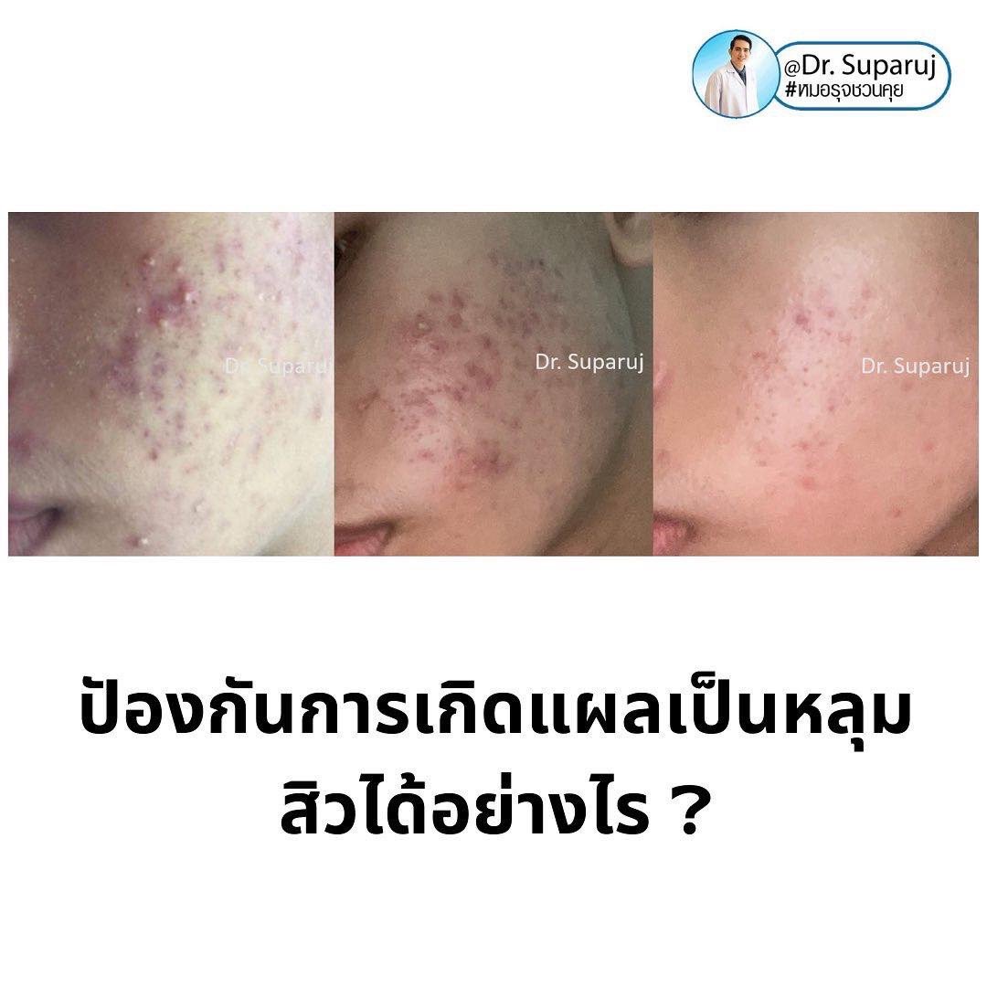 ปัจจัยเสี่ยงที่ทำให้เกิดแผลเป็นหลุมสิวมีอะไรบ้าง ? และปัองกันการเกิดแผลเป็นหลุมสิวได้อย่างไร ? ปัจจัยเสี่ยงที่ทำให้เกิดแผลเป็นหลุมสิวมีอะไรบ้าง ? และปัองกันการเกิดแผลเป็นหลุมสิวได้อย่างไร ?