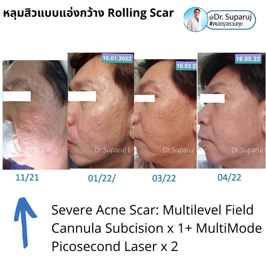 เลเซอร์ Picosecond Laser ช่วยดูแลหลุมสิวดีขึ้นต่อเนื่องถึงเดือนที่ 6 หลังการรักษาครั้งสุดท้าย  