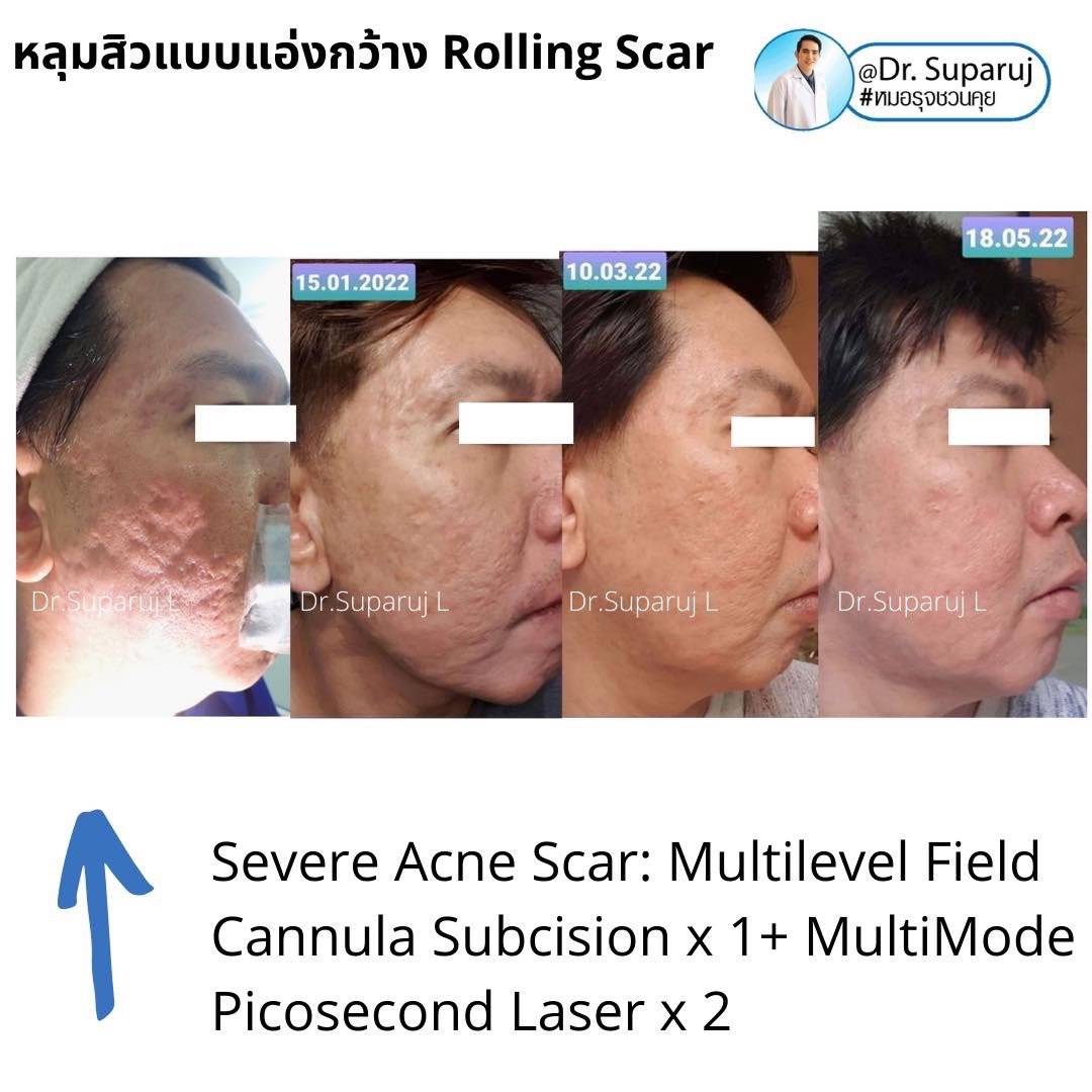 เลเซอร์ Picosecond Laser ช่วยดูแลหลุมสิวดีขึ้นต่อเนื่องถึงเดือนที่ 6 หลังการรักษาครั้งสุดท้าย   เลเซอร์ Picosecond Laser ช่วยดูแลหลุมสิวดีขึ้นต่อเนื่องถึงเดือนที่ 6 หลังการรักษาครั้งสุดท้าย
