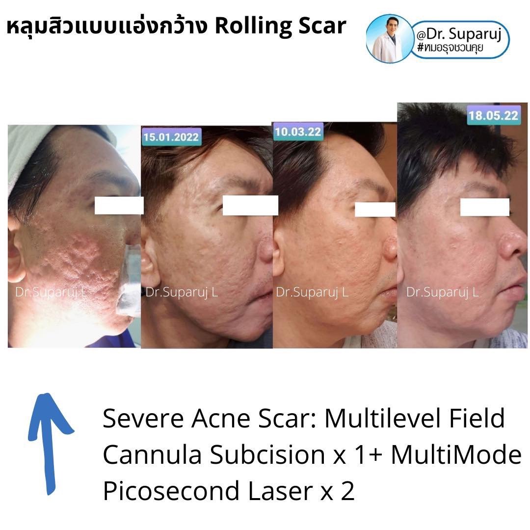 เลเซอร์ Picosecond Laser ช่วยดูแลหลุมสิวดีขึ้นต่อเนื่องถึงเดือนที่ 6 หลังการรักษาครั้งสุดท้าย  