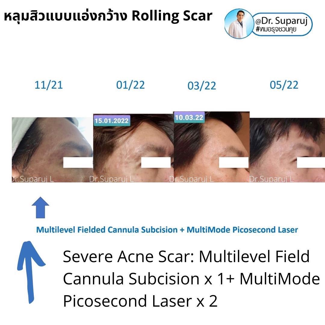 เลเซอร์ Picosecond Laser ช่วยดูแลหลุมสิวดีขึ้นต่อเนื่องถึงเดือนที่ 6 หลังการรักษาครั้งสุดท้าย   เลเซอร์ Picosecond Laser ช่วยดูแลหลุมสิวดีขึ้นต่อเนื่องถึงเดือนที่ 6 หลังการรักษาครั้งสุดท้าย