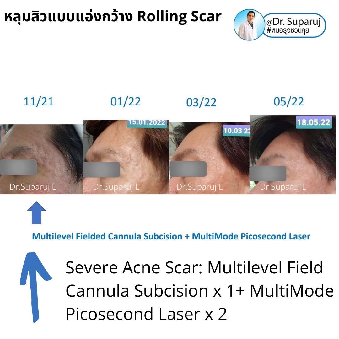 เลเซอร์ Picosecond Laser ช่วยดูแลหลุมสิวดีขึ้นต่อเนื่องถึงเดือนที่ 6 หลังการรักษาครั้งสุดท้าย  