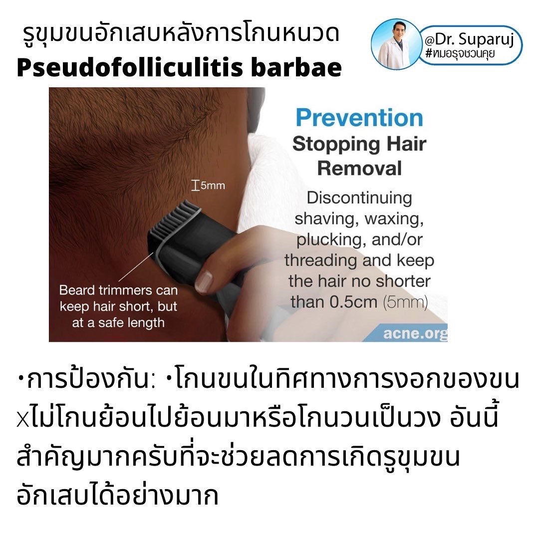 คล้ายสิว…แต่ไม่ใช่สิว: รูขุมขนอักเสบหลังการโกนหนวด Pseudofolliculitis barbae, Razor bump +เทคนิคการโกนหนวดเพื่อลดการเกิดรูขุมขนอักเสบครับ คล้ายสิว…แต่ไม่ใช่สิว: รูขุมขนอักเสบหลังการโกนหนวด Pseudofolliculitis barbae, Razor bump +เทคนิคการโกนหนวดเพื่อลดการเกิดรูขุมขนอักเสบครับ
