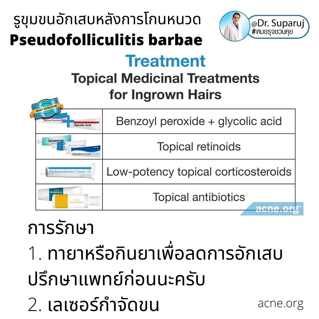 คล้ายสิว…แต่ไม่ใช่สิว: รูขุมขนอักเสบหลังการโกนหนวด Pseudofolliculitis barbae, Razor bump +เทคนิคการโกนหนวดเพื่อลดการเกิดรูขุมขนอักเสบครับ คล้ายสิว…แต่ไม่ใช่สิว: รูขุมขนอักเสบหลังการโกนหนวด Pseudofolliculitis barbae, Razor bump +เทคนิคการโกนหนวดเพื่อลดการเกิดรูขุมขนอักเสบครับ