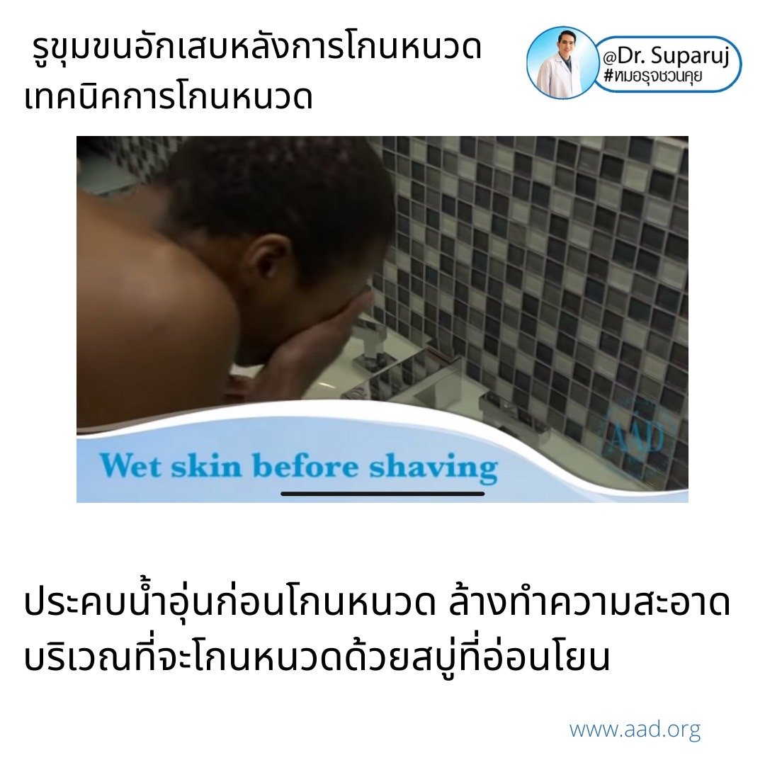 คล้ายสิว…แต่ไม่ใช่สิว: รูขุมขนอักเสบหลังการโกนหนวด Pseudofolliculitis barbae, Razor bump +เทคนิคการโกนหนวดเพื่อลดการเกิดรูขุมขนอักเสบครับ