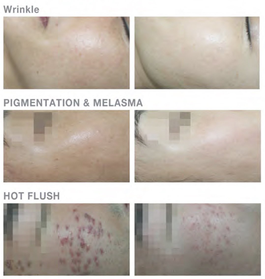 Intradermal Air – Dissector นวัตกรรมดูแลหลุมสิว ตัดพังผืดด้วยแรงดันอากาศ คืนผิวเรียบเนียน Intradermal Air – Dissector นวัตกรรมดูแลหลุมสิว ตัดพังผืดด้วยแรงดันอากาศ คืนผิวเรียบเนียน