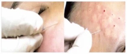 Intradermal Air – Dissector นวัตกรรมดูแลหลุมสิว ตัดพังผืดด้วยแรงดันอากาศ คืนผิวเรียบเนียน Intradermal Air – Dissector นวัตกรรมดูแลหลุมสิว ตัดพังผืดด้วยแรงดันอากาศ คืนผิวเรียบเนียน