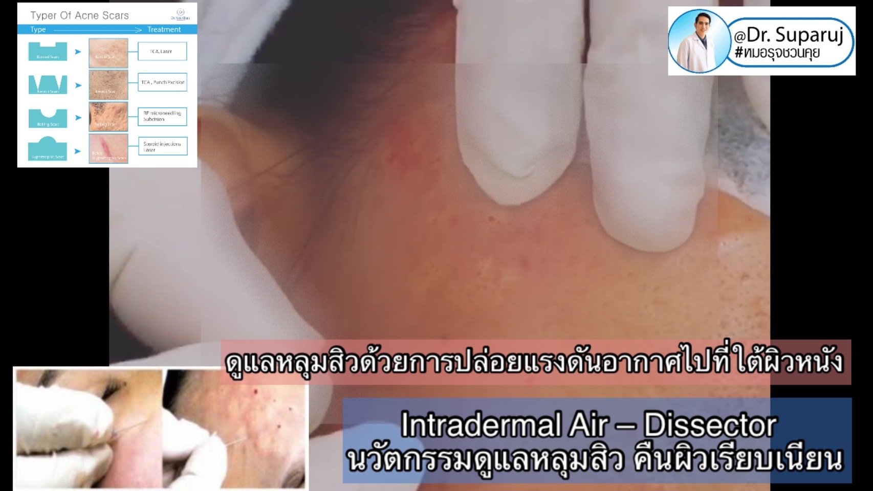 Intradermal Air – Dissector นวัตกรรมดูแลหลุมสิว ตัดพังผืดด้วยแรงดันอากาศ คืนผิวเรียบเนียน Intradermal Air – Dissector นวัตกรรมดูแลหลุมสิว ตัดพังผืดด้วยแรงดันอากาศ คืนผิวเรียบเนียน