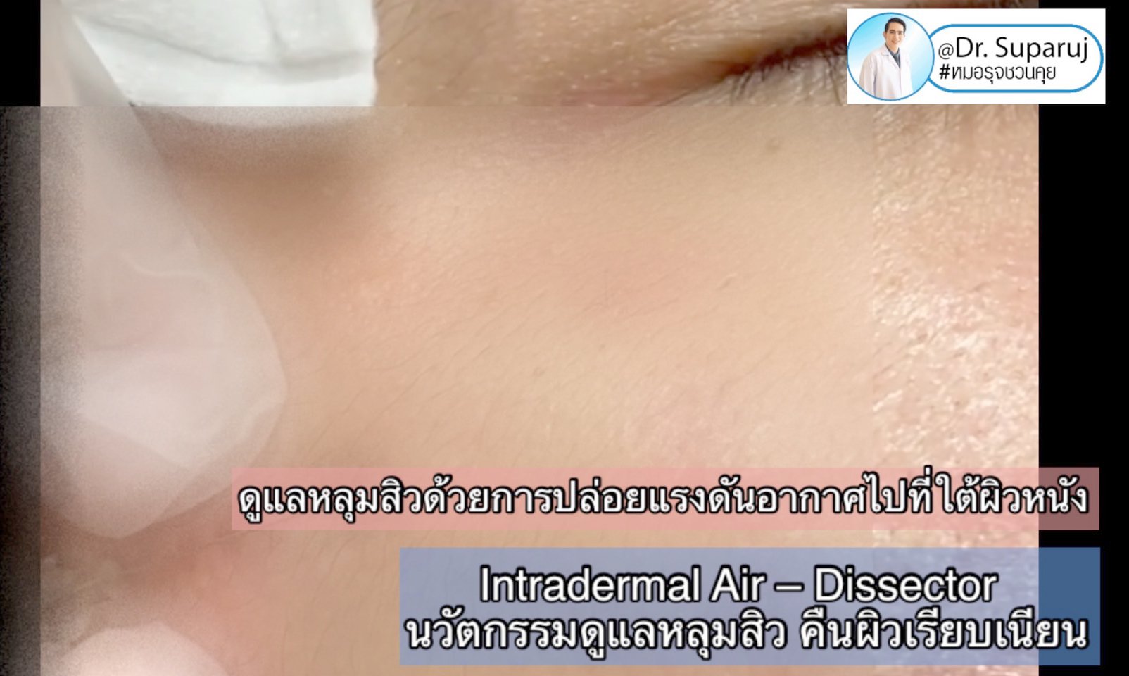 Intradermal Air – Dissector นวัตกรรมดูแลหลุมสิว ตัดพังผืดด้วยแรงดันอากาศ คืนผิวเรียบเนียน Intradermal Air – Dissector นวัตกรรมดูแลหลุมสิว ตัดพังผืดด้วยแรงดันอากาศ คืนผิวเรียบเนียน