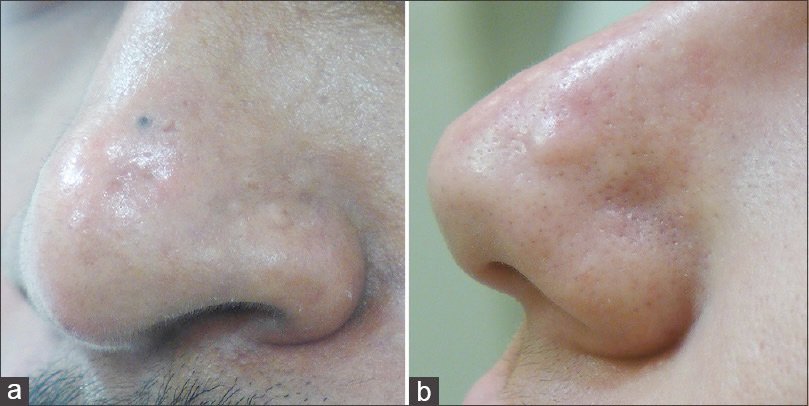 แผลเป็นจากสิวแบบนูน Papular acne scar คืออะไร ? ดูแลได้อย่างไร ? แผลเป็นจากสิวแบบนูน Papular acne scar คืออะไร ? ดูแลได้อย่างไร ?