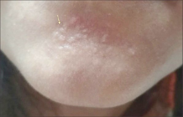 แผลเป็นจากสิวแบบนูน Papular acne scar คืออะไร ? ดูแลได้อย่างไร ? แผลเป็นจากสิวแบบนูน Papular acne scar คืออะไร ? ดูแลได้อย่างไร ?