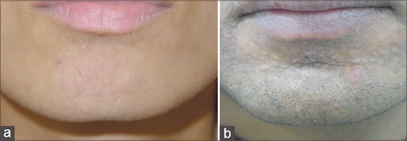 แผลเป็นจากสิวแบบนูน Papular acne scar คืออะไร ? ดูแลได้อย่างไร ? แผลเป็นจากสิวแบบนูน Papular acne scar คืออะไร ? ดูแลได้อย่างไร ?