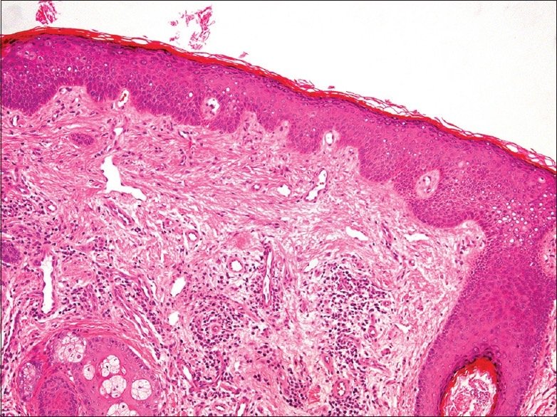 แผลเป็นจากสิวแบบนูน Papular acne scar คืออะไร ? ดูแลได้อย่างไร ?