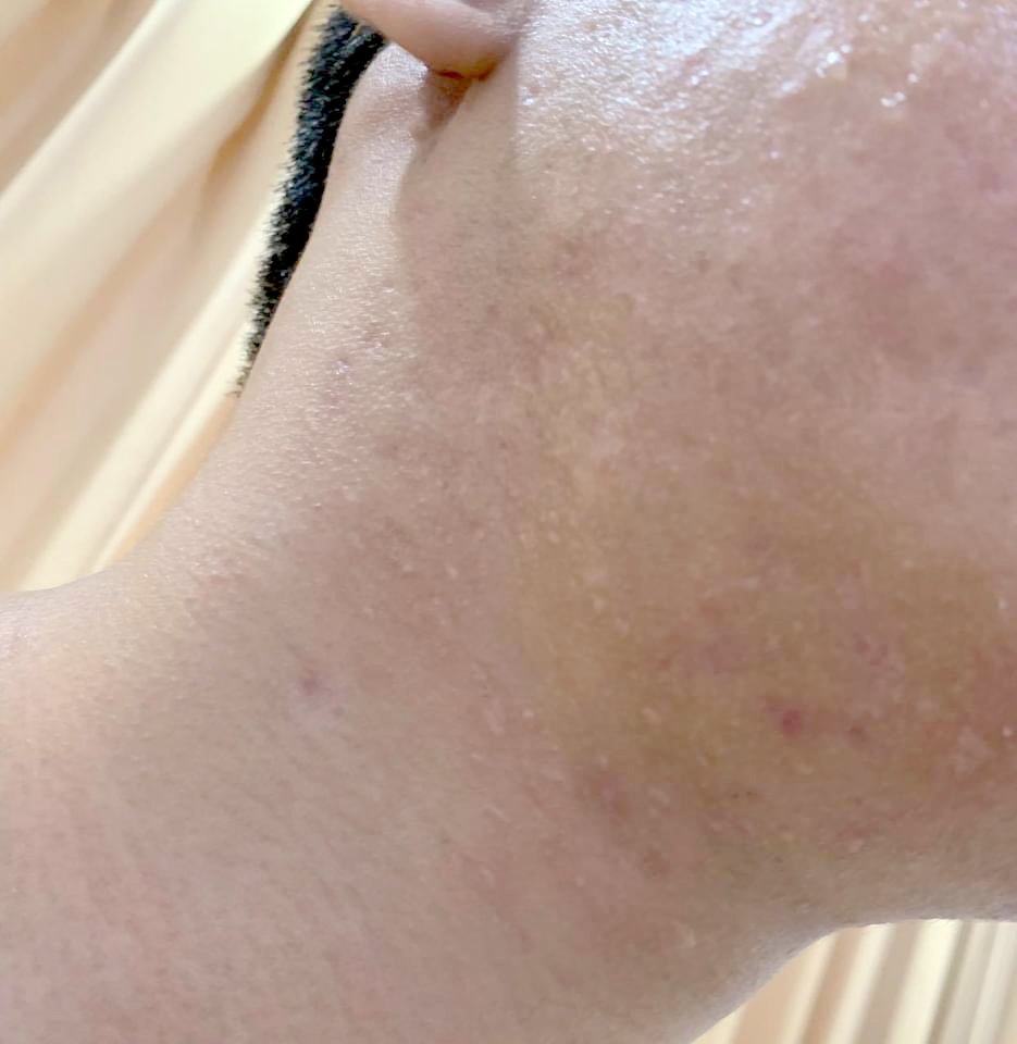 แผลเป็นจากสิวแบบนูน Papular acne scar คืออะไร ? ดูแลได้อย่างไร ?