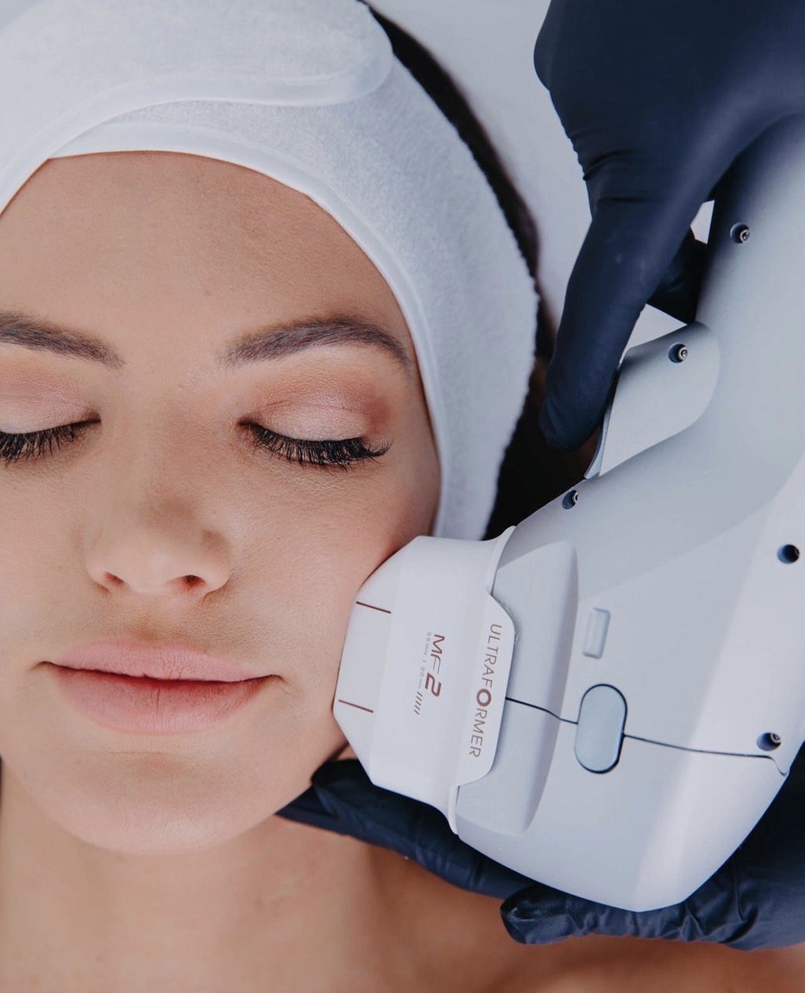 Ultraformer lll หัวยิง MF2 (2.0mm or “MF2” Cartridge) ลดเลือนริ้วรอยรอบดวงตายกกระชับหนังตา ยกคิ้ว Ultraformer lll หัวยิง MF2 (2.0mm or “MF2” Cartridge) ลดเลือนริ้วรอยรอบดวงตายกกระชับหนังตา ยกคิ้ว