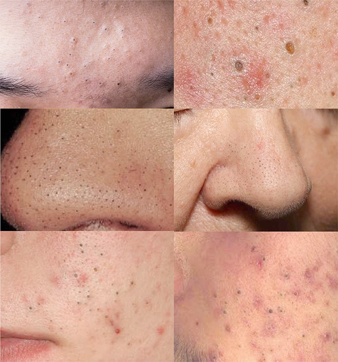 สิวเสี้ยนดูแลอย่างไร blackhead on nose/ Trichostasis Spinulosa? สิวเสี้ยนดูแลอย่างไร blackhead on nose/ Trichostasis Spinulosa?