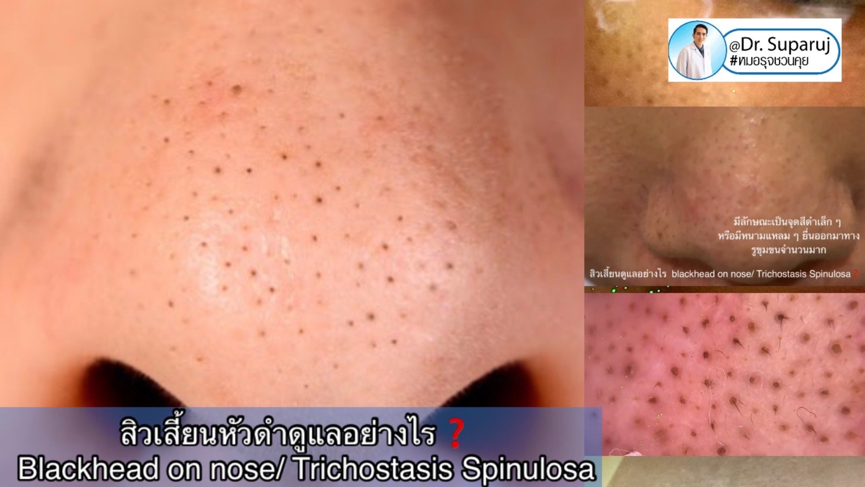 สิวเสี้ยนดูแลอย่างไร blackhead on nose/ Trichostasis Spinulosa? สิวเสี้ยนดูแลอย่างไร blackhead on nose/ Trichostasis Spinulosa?