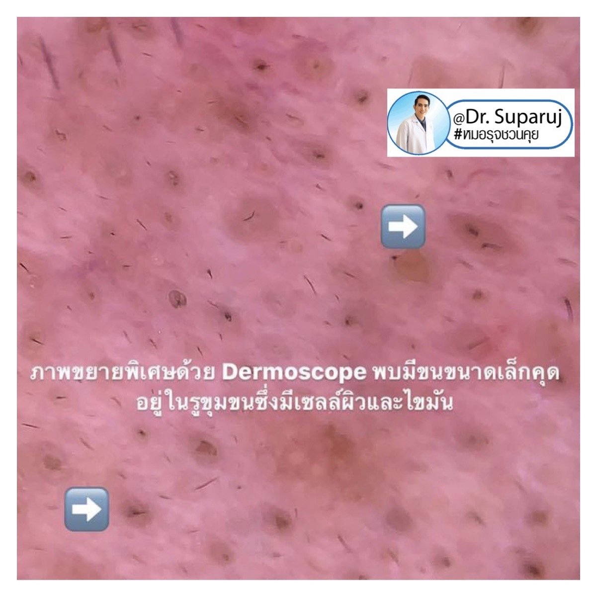 สิวเสี้ยนดูแลอย่างไร blackhead on nose/ Trichostasis Spinulosa? สิวเสี้ยนดูแลอย่างไร blackhead on nose/ Trichostasis Spinulosa?