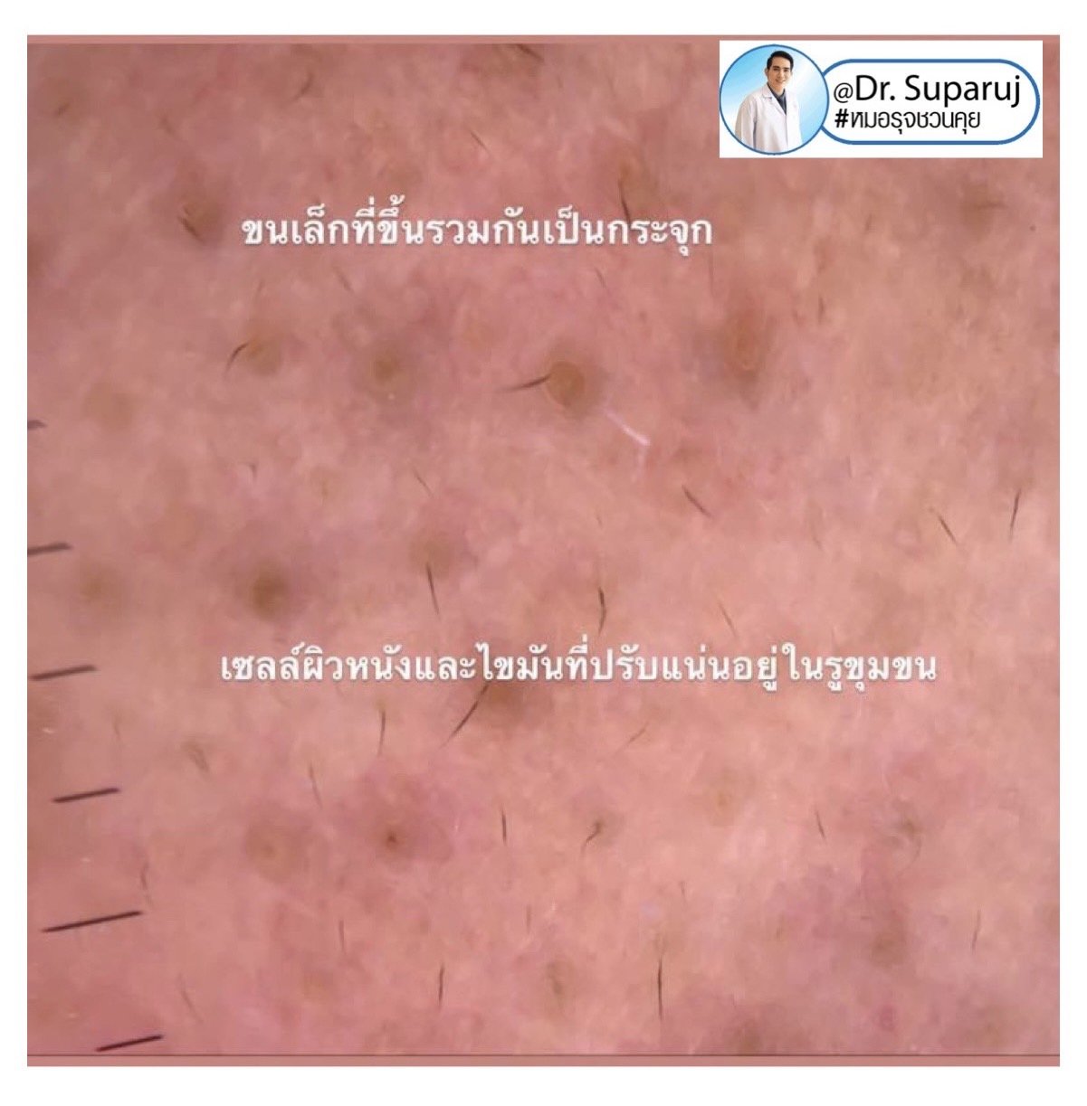 สิวเสี้ยนดูแลอย่างไร blackhead on nose/ Trichostasis Spinulosa? สิวเสี้ยนดูแลอย่างไร blackhead on nose/ Trichostasis Spinulosa?