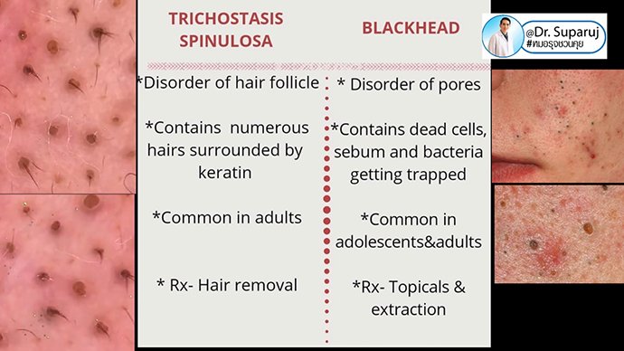 สิวเสี้ยนดูแลอย่างไร blackhead on nose/ Trichostasis Spinulosa? สิวเสี้ยนดูแลอย่างไร blackhead on nose/ Trichostasis Spinulosa?