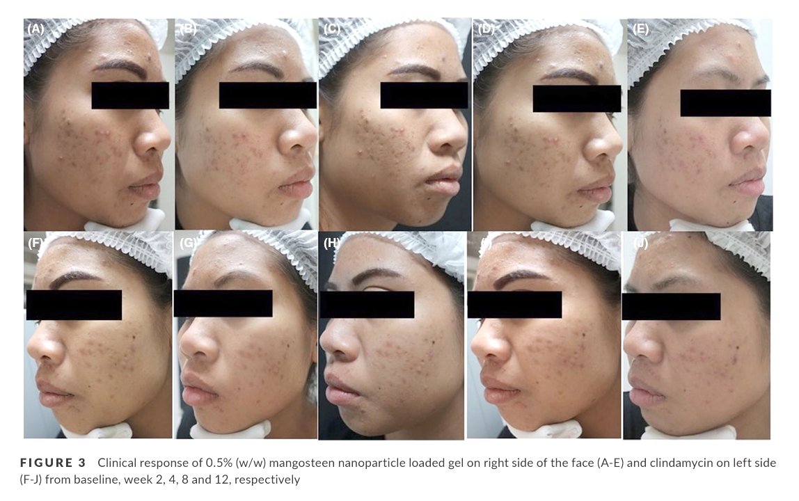 New Year New Healthy Skin ดูแลรักษา 3 ปัญหา คือ สิว หลุมสิว และ แผลเป็น โดยไม่มีค่าใช้จ่ายโดยหมอรุจที่ DeMed Clinic ครับ New Year New Healthy Skin ดูแลรักษา 3 ปัญหา คือ สิว หลุมสิว และ แผลเป็น โดยไม่มีค่าใช้จ่ายโดยหมอรุจที่ DeMed Clinic ครับ